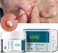 Acne Cream - Crown Cart
